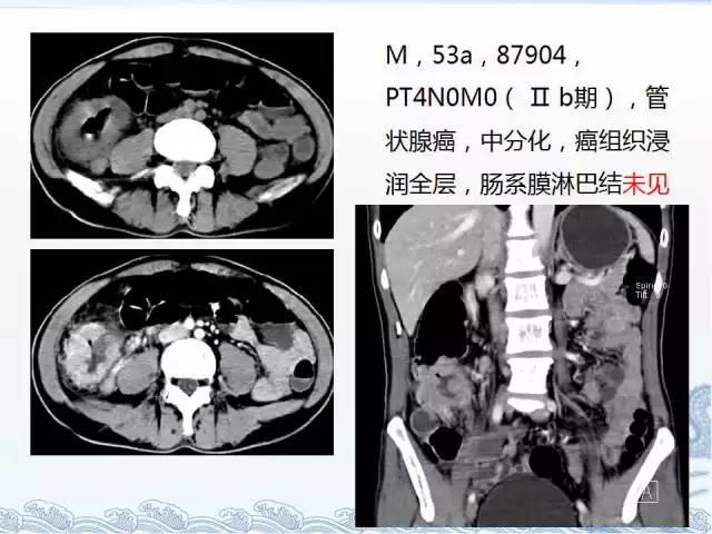 ct检查及诊断攻略—胃癌,结直肠癌