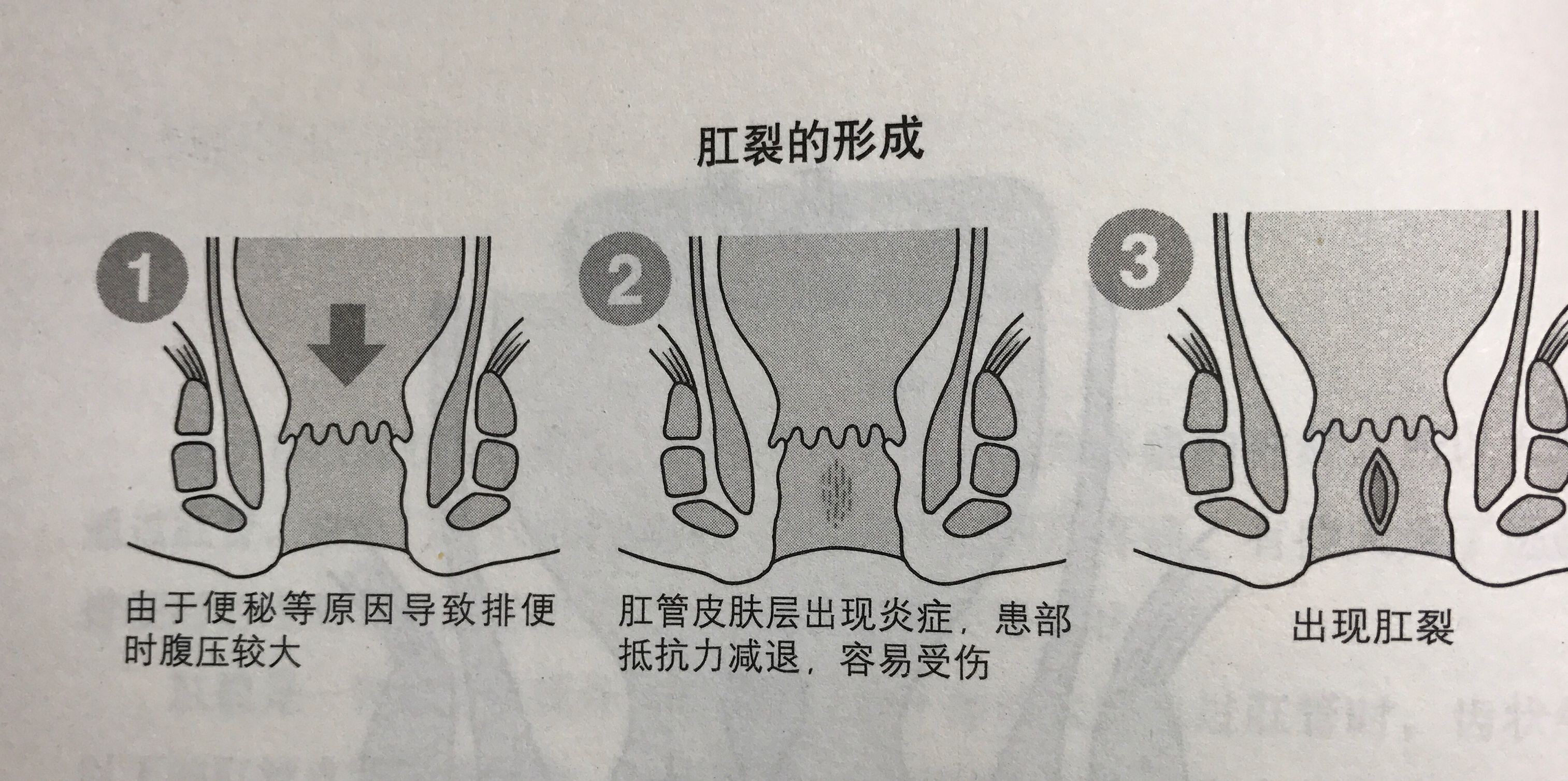 你为什么会患肛裂?