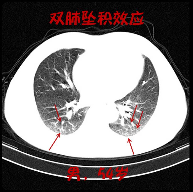 吸烟者的肺,看完果断戒烟吧!