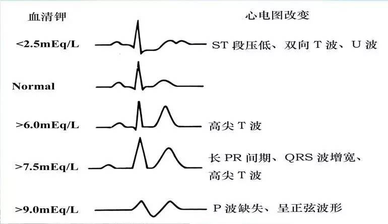 高血钾心电图_高血钾心电图改变