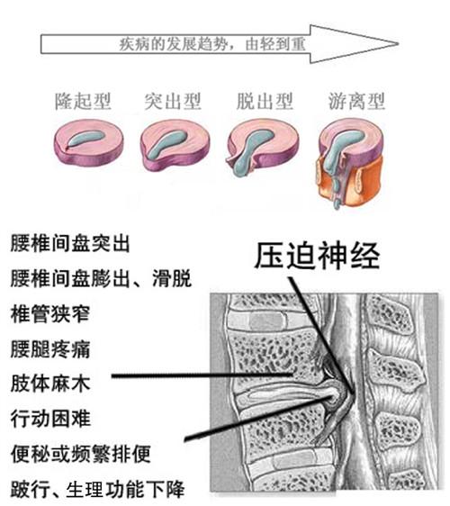 腰椎间盘突出腰疼和腿麻哪个严重