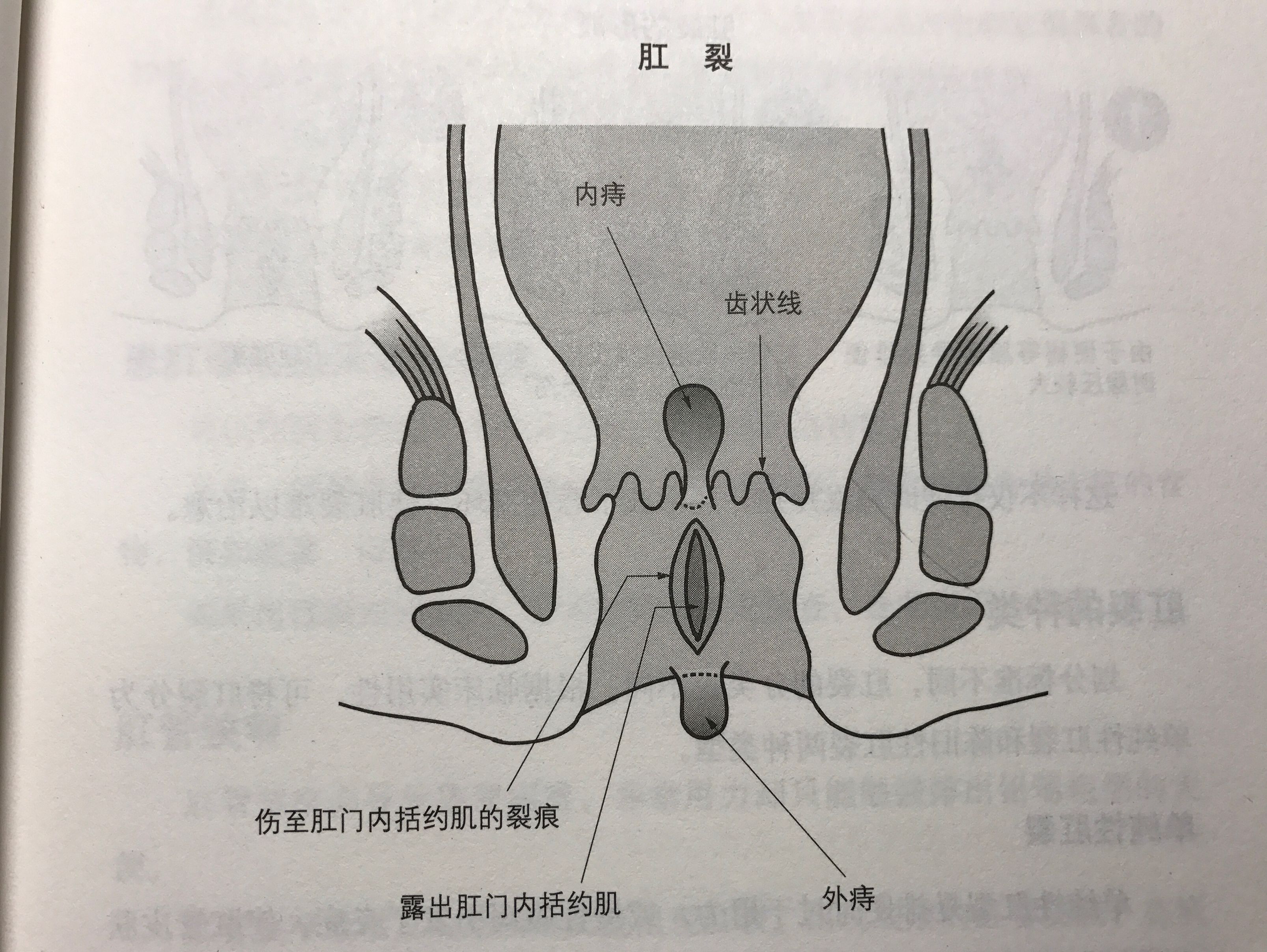 齿状线以下的肛管皮肤层被划伤,造成肛裂,其症状有首页 中医养生 >