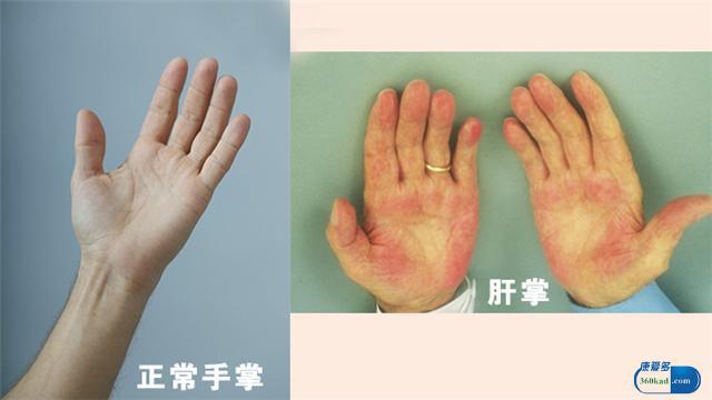 大病信号看手掌就能知:手掌透露的多种疾病风险