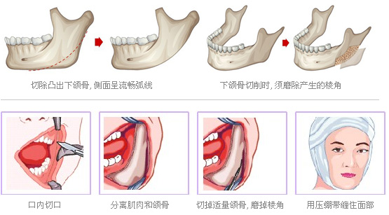 高低脸怎么办