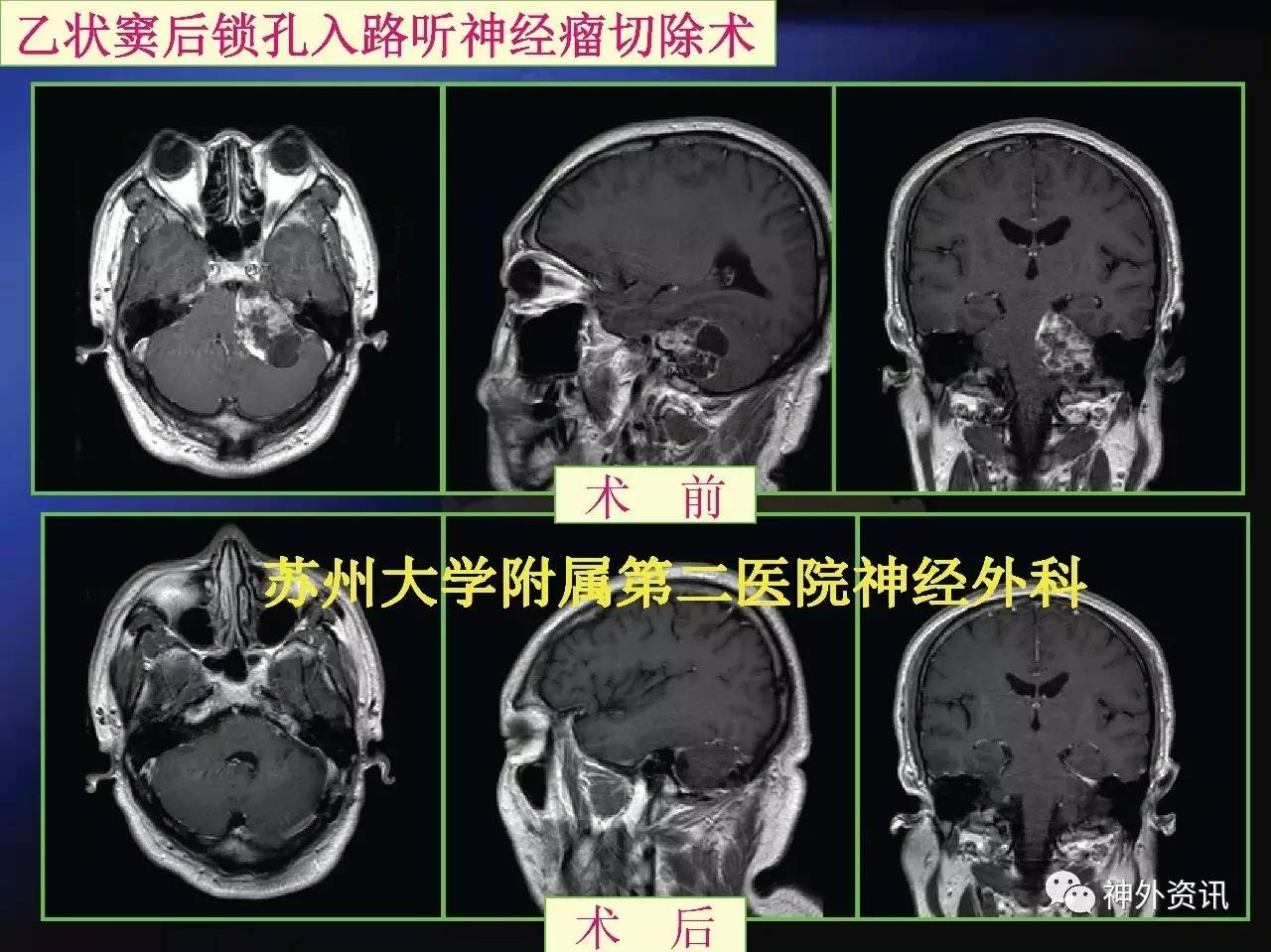 【正海-妙术视界】| 陈刚教授:乙状窦后锁孔入路听神经瘤切除术