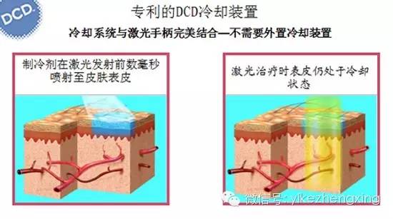 vbeam 脉冲染料激光-治疗血管性病变的金标准