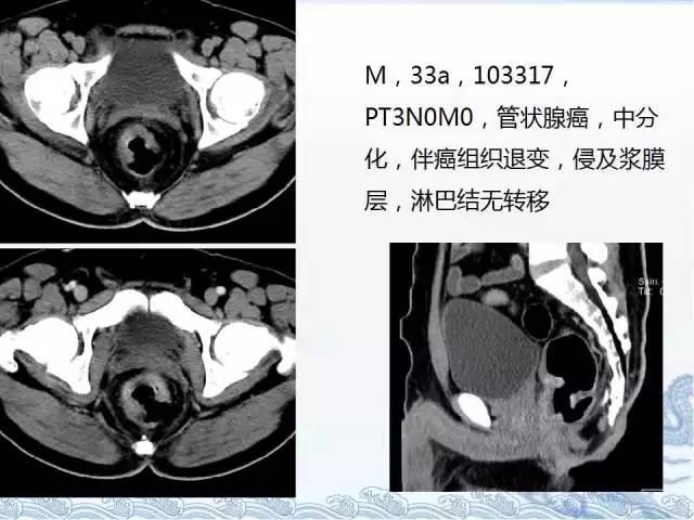 ct检查及诊断攻略——胃癌,结直肠癌