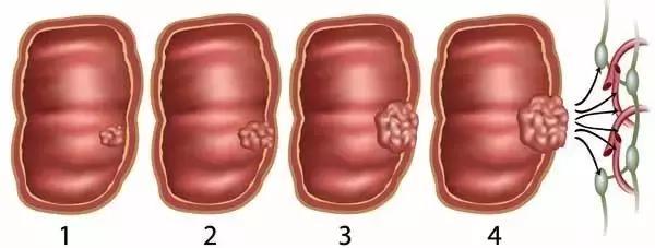 三,80%的大肠癌都是肠息肉引起 及早做肠镜