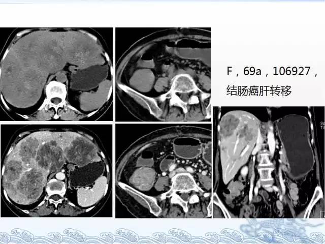 ct检查及诊断攻略——胃癌,结直肠癌