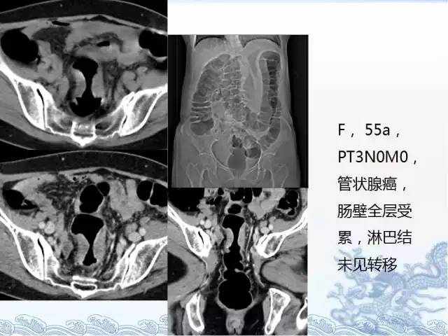 ct检查及诊断攻略—胃癌,结直肠癌