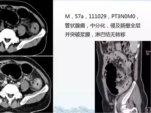 ct检查及诊断攻略——胃癌,结直肠癌