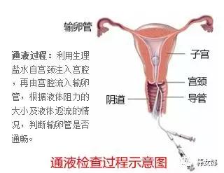 棒女郎:输卵管造影与通水哪个好?选对检查早怀