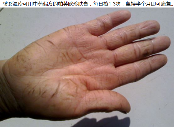 首页 中医养生 > 正文     手部皮肤皲裂性湿疹是由于皮肤表面角化