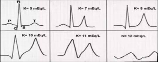 心电图的主要表现是t波,t波,t波;并不是所有高钾血症t波都必须高耸.