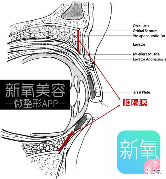 这个眶隔膜会随着我们的衰老,张力减退.