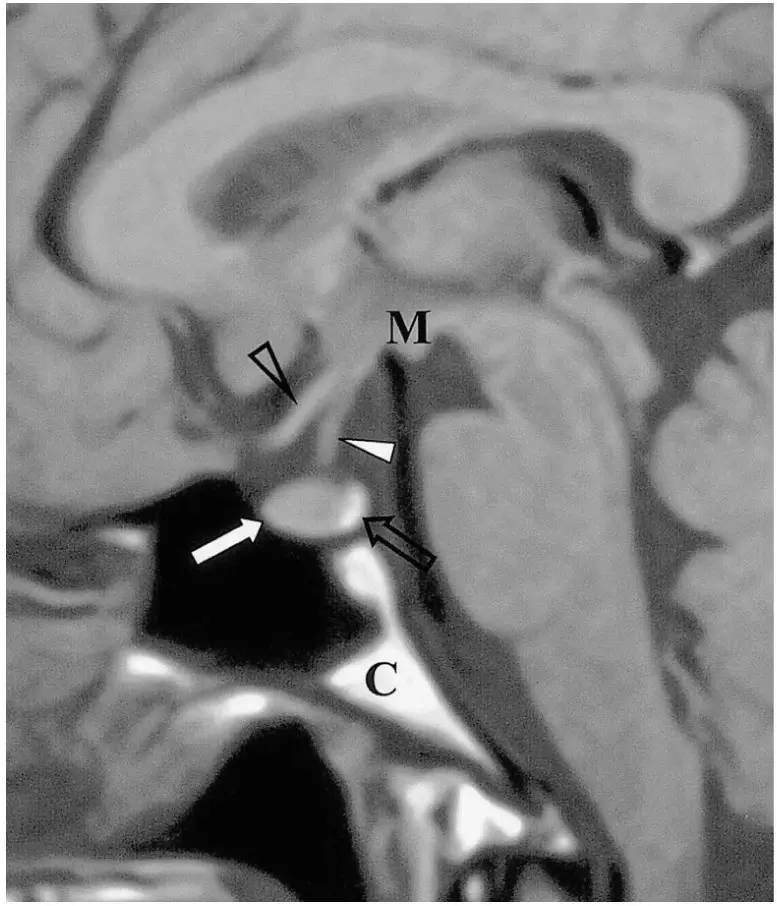 图八 正常垂体 mri t1 加权像