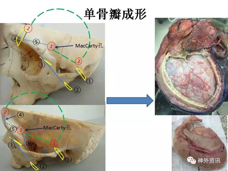 手术视频| 刘振林教授团队:sta-m3搭桥,复发听神经瘤切除手术,dolenc