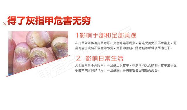 灰指甲其实是一种指甲真菌病,一般以皮肤廯菌最常见,有的是其他