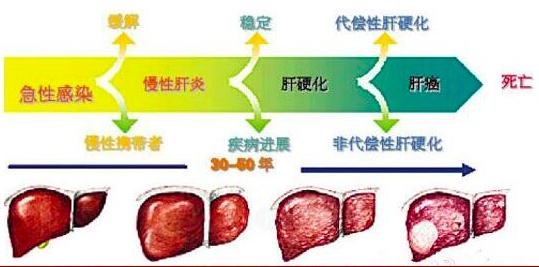 症状三:乏力 肝癌患者的乏力与慢性肝炎类似,并且较其他肿瘤患者可能