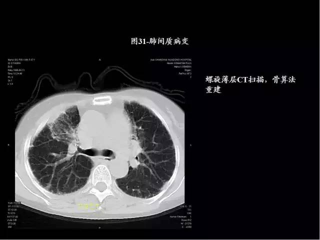 史上最全肺CT分段及典型疾病影像