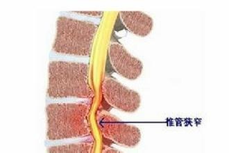 李铁红:腰椎椎管狭窄了怎么办?如何用埋线治疗