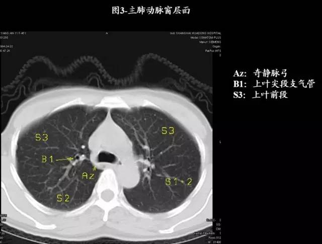 史上最全肺CT分段及典型疾病影像
