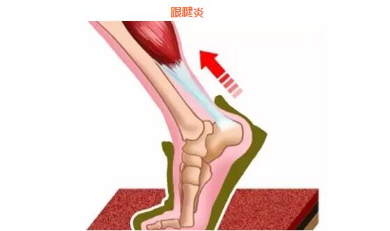 首页 【组图】铁三运动员常见的运动损伤及预防方法       阿基里斯腱