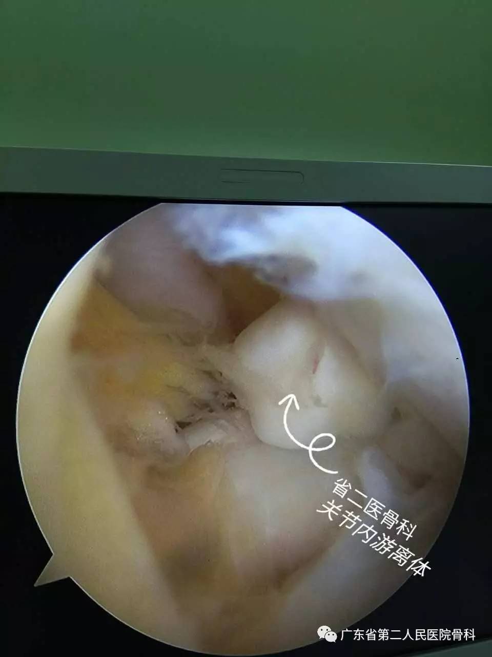 膝关节内游离体科普与案例分享