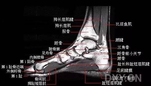 骨哥阅片课堂:10分钟掌握踝关节 mri