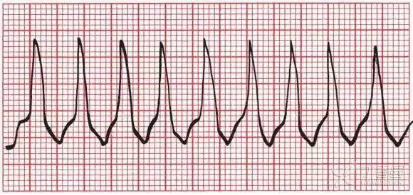 漫话心律失常:那些「不正经」的室速与室上速