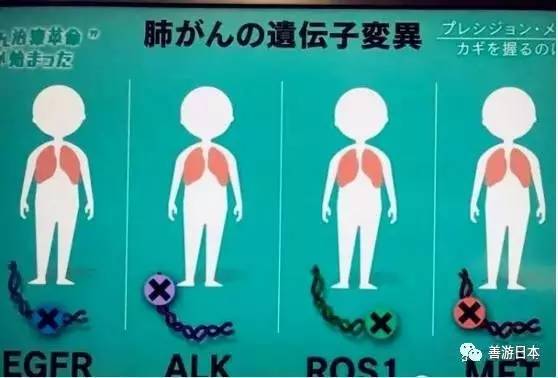 日本已经可以治疗肺癌了!