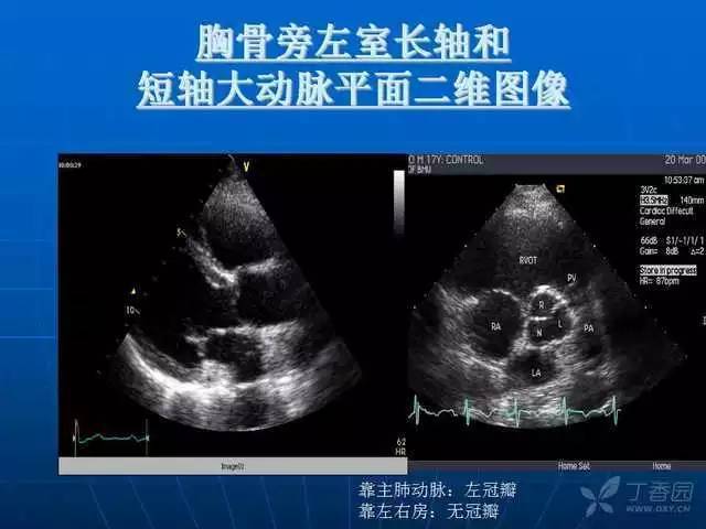 精彩幻灯:超声心动图标准切面及正常值