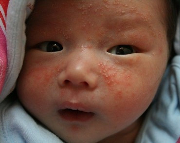 2岁以上宝宝湿疹用什么药好?