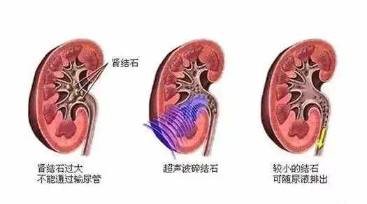 不要害怕肾结石, 一款中药能排石, 帮你日常保健