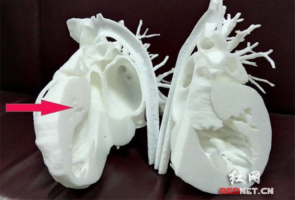 湘雅二医院:3D打印心脏 为手术提供最精确参考