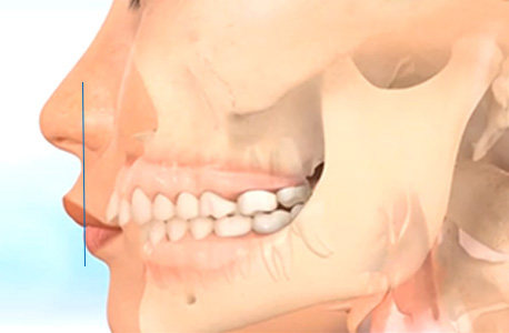 戴牙套的脸型变化过程
