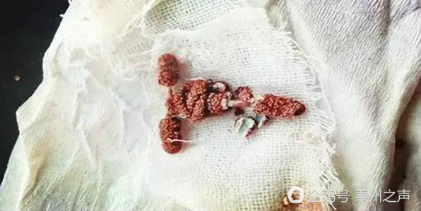 泰州女子二胎后被安排去上环,三个多月后却怀孕了