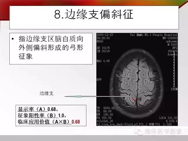 收藏!横断面脑沟回十大征象