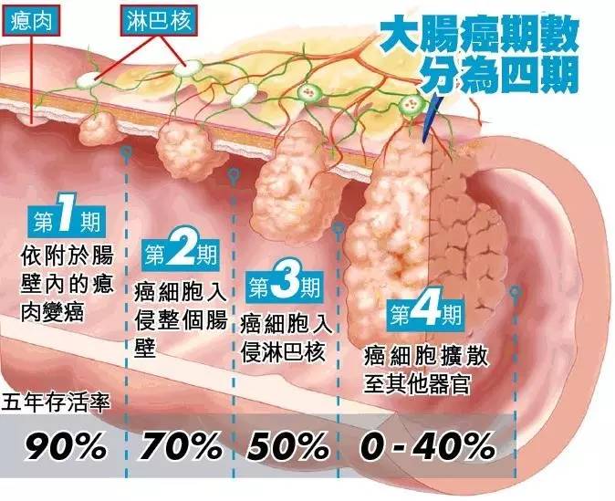 结肠镜筛查如何预防结肠癌 都说大肠息肉是大肠癌的"前奏",实际上