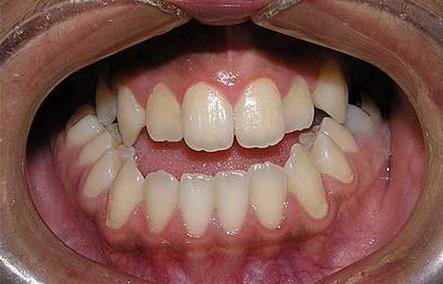 您的牙齿出现这一症状应及时矫正!