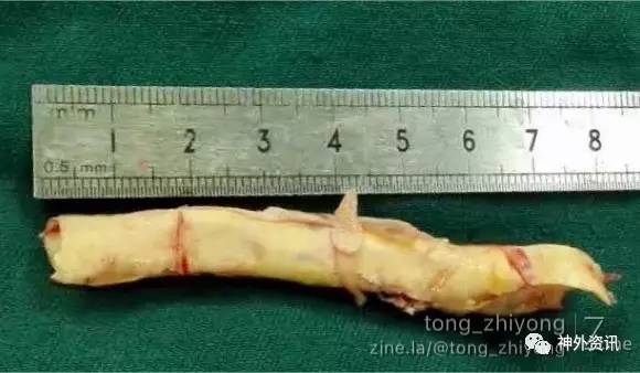 病例分享| 80mm超长右侧颈动脉硬化斑块切除术-搜狐