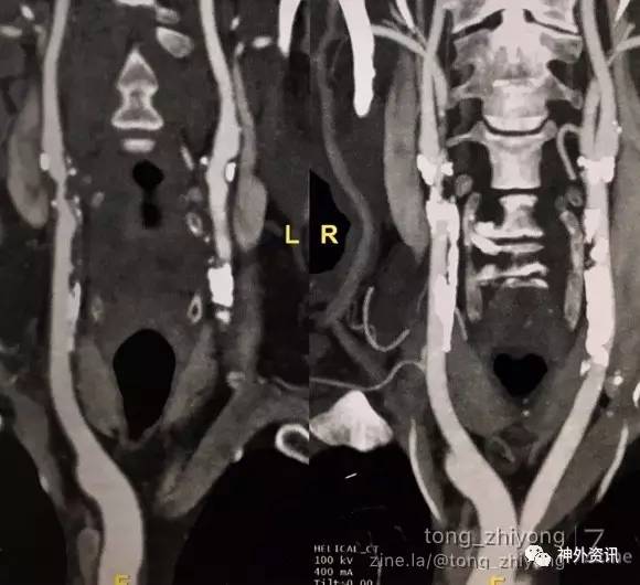 动脉硬化检测的原理是什么_动脉硬化检测(3)