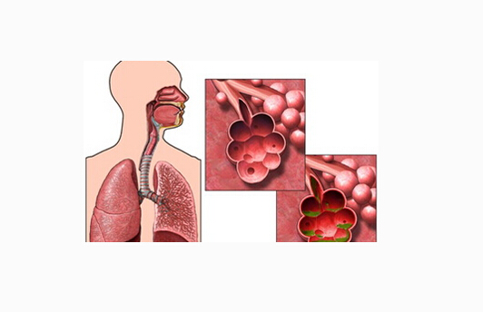 咳嗽久治不愈,可能是这6种重大肺病,肺癌最严