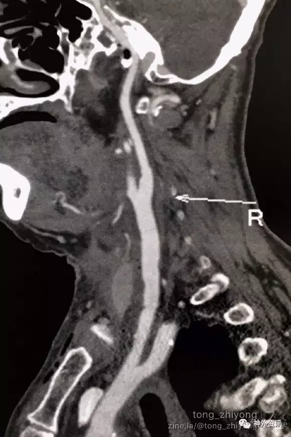 病例分享| 80mm超长右侧颈动脉硬化斑块切除