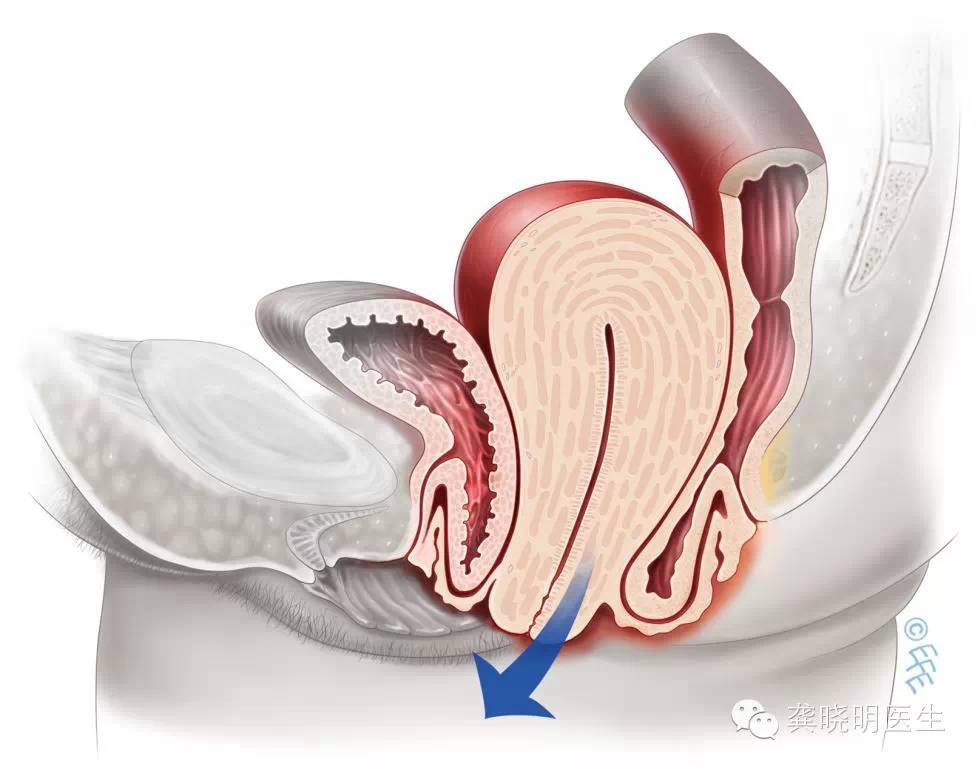 子宫脱垂阴道壁膨出了怎么办