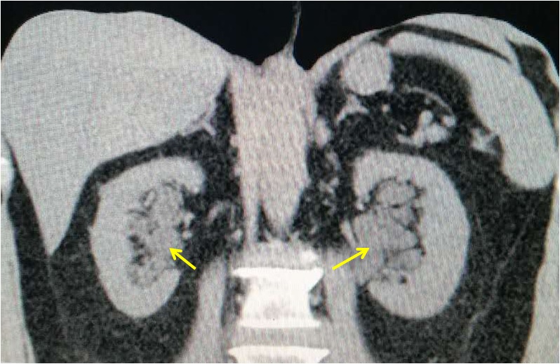 b超诊断双肾积水ct却是另外一种病