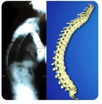 颈椎c4-5关节的退化,胸椎t4-5的退化,颈椎曲度变直,胸椎曲度增加(也就
