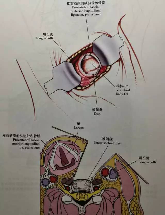 如果后纵韧带破裂的话,需要切除后纵韧带并将游离的椎间盘取出.