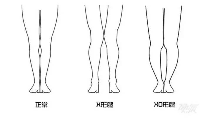 如何避免不完美腿型 站