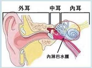 这是一种由于内耳迷路动脉痉挛导致的迷路水肿,或是内耳迷路的炎症所